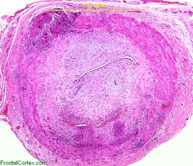 Temporal Arteritis Low Power H&E